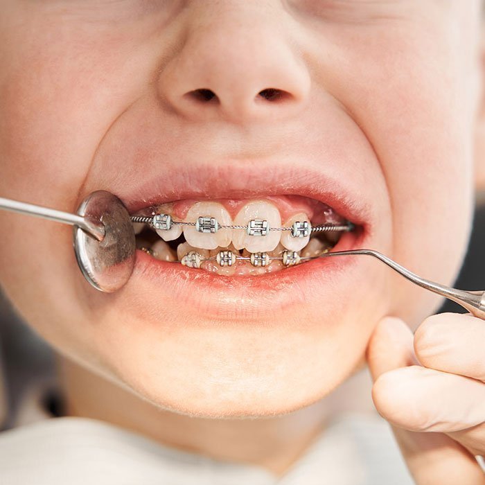 Early Orthodontic Intervention