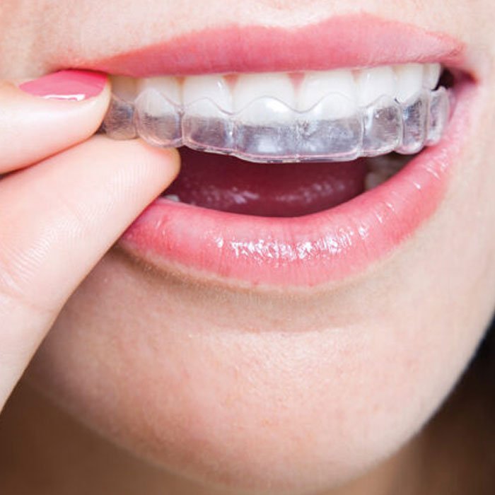 Invisalign Clear Aligners