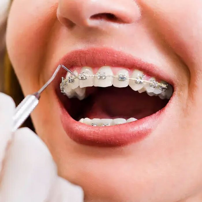 Traditional Braces